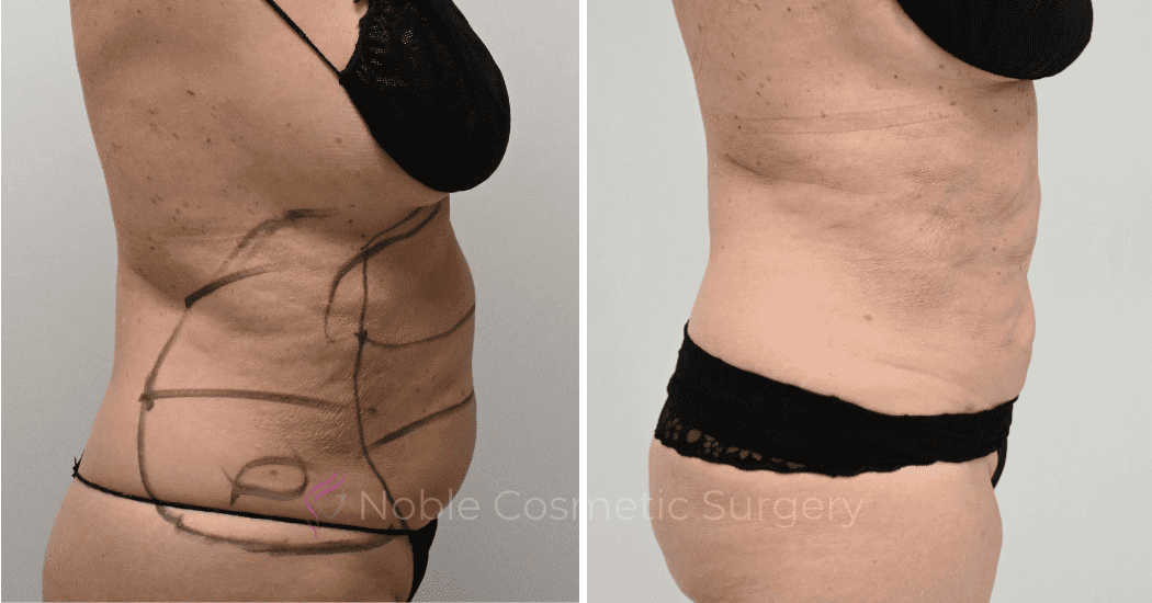 LIPOSUCTION-CASE-10145 | Before and After Liposuction 4