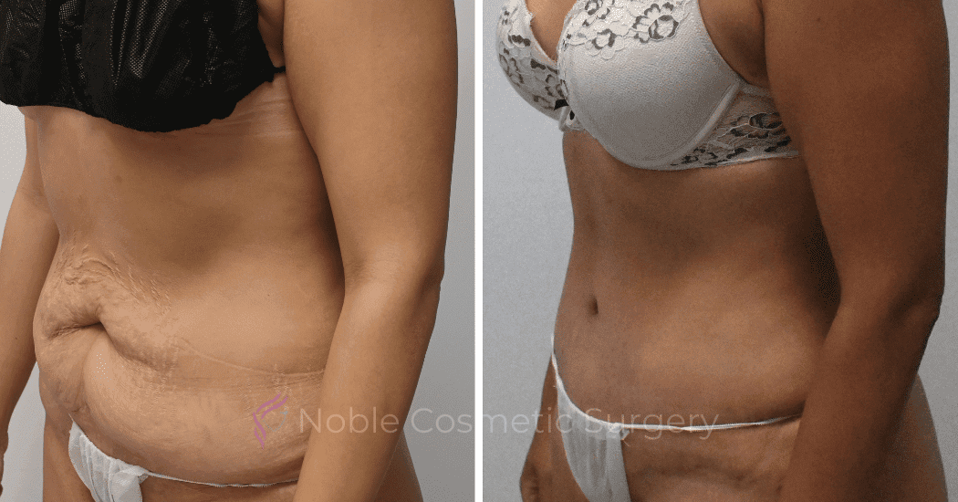 TUMMY-TUCK-CASE-12792 | Before and After Abdominoplasty 3