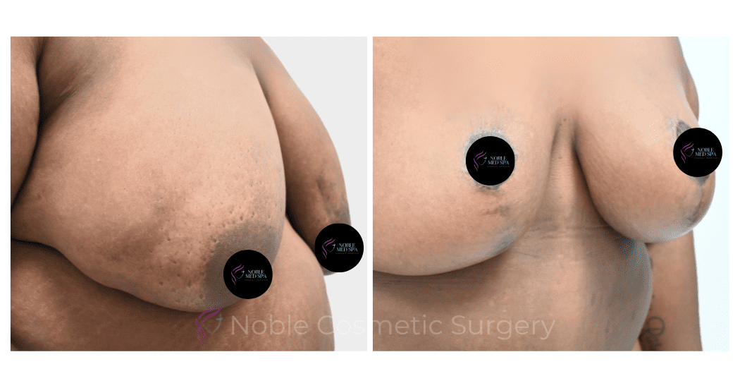BREAST-REDUCTION-CASE-00804 | Before and After Breast Reduction 2