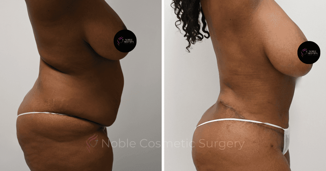TUMMY-TUCK-CASE-14435 | Before and After Abdominoplasty 3