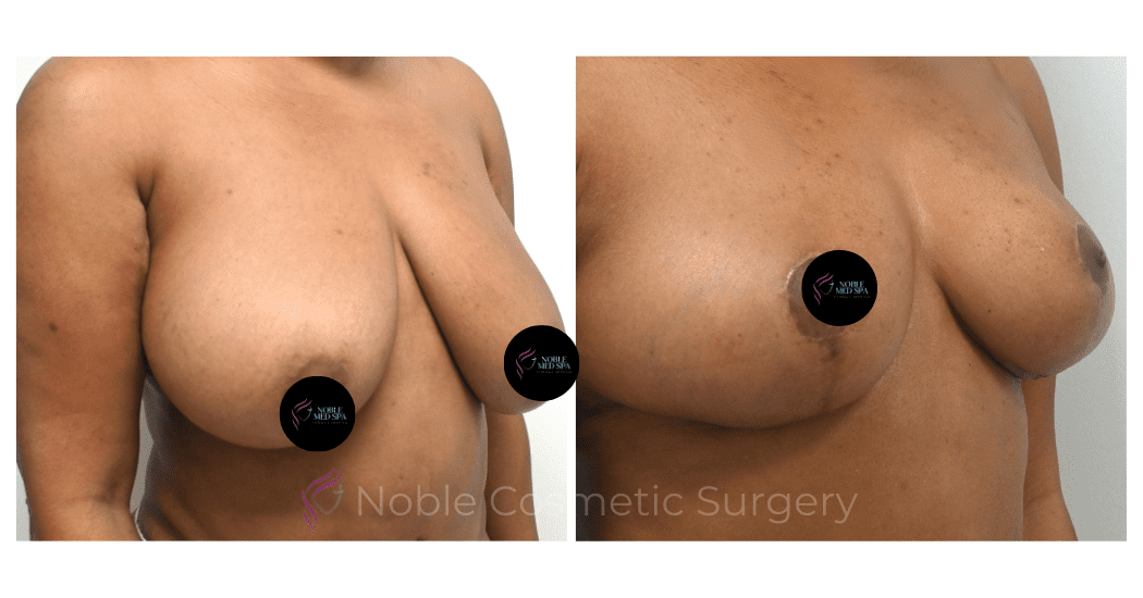 BREAST-REDUCTION-CASE-00805 | Before and After Breast Reduction 2