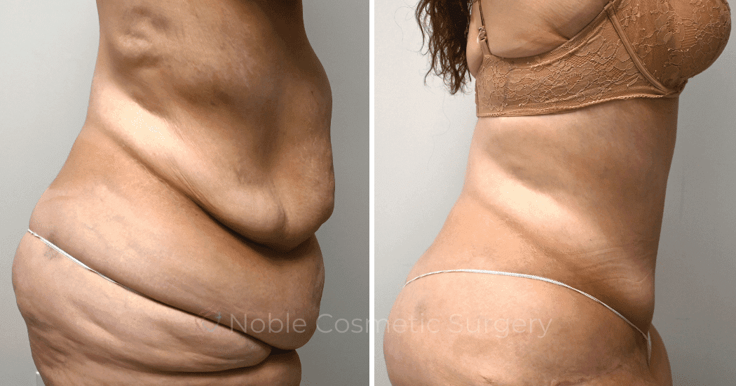 TUMMY-TUCK-CASE-10950 | Before and After Abdominoplasty 3