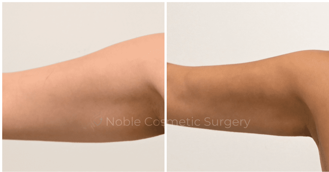 LIPOSUCTION-ARMS-CASE-00316 | Before and After Arm Liposuction 2