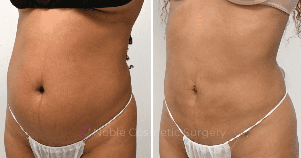 LIPOSUCTION-ABDOMEN-CASE--10533 | Before and After Liposuction 3