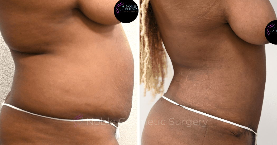 TUMMY-TUCK-CASE-13859 | Before and After Abdominoplasty 3