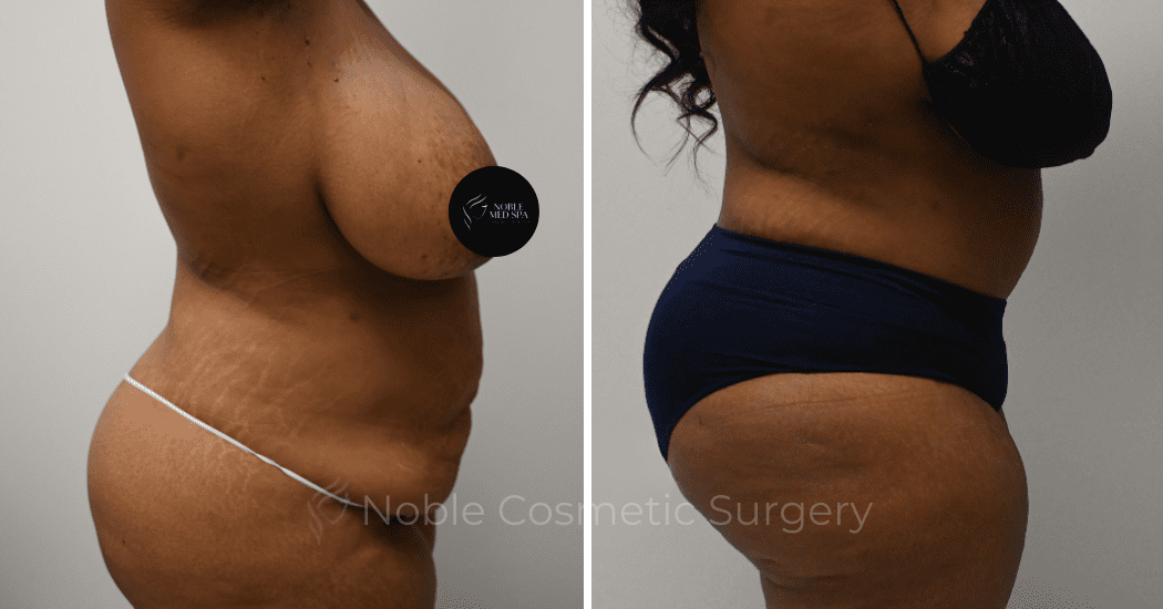 TUMMY-TUCK-CASE-14522 | Before and After Abdominoplasty 3