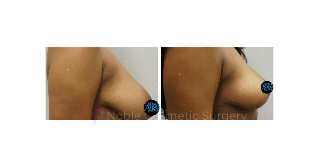 BREAST-LIFT-CASE-00675 | Before and After Breast Lift 2