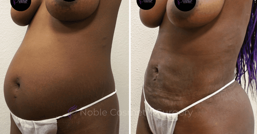 LIPOSUCTION-ABDOMEN-CASE-15104 | Before and After Liposuction 3