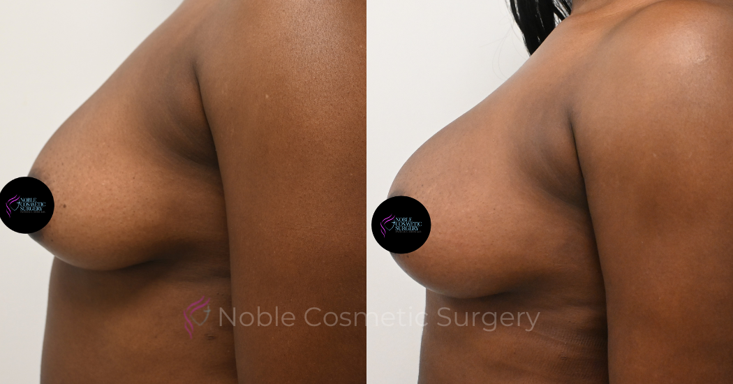 BREAST-AUGMENTATION--WITH-FAT-TRANSFER--CASE-10946 | Before and After Breast Augmentation 3