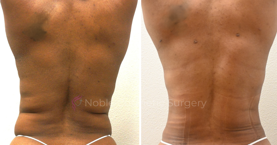 TUMMY-TUCK-CASE-00034 | Before and After Abdominoplasty 3