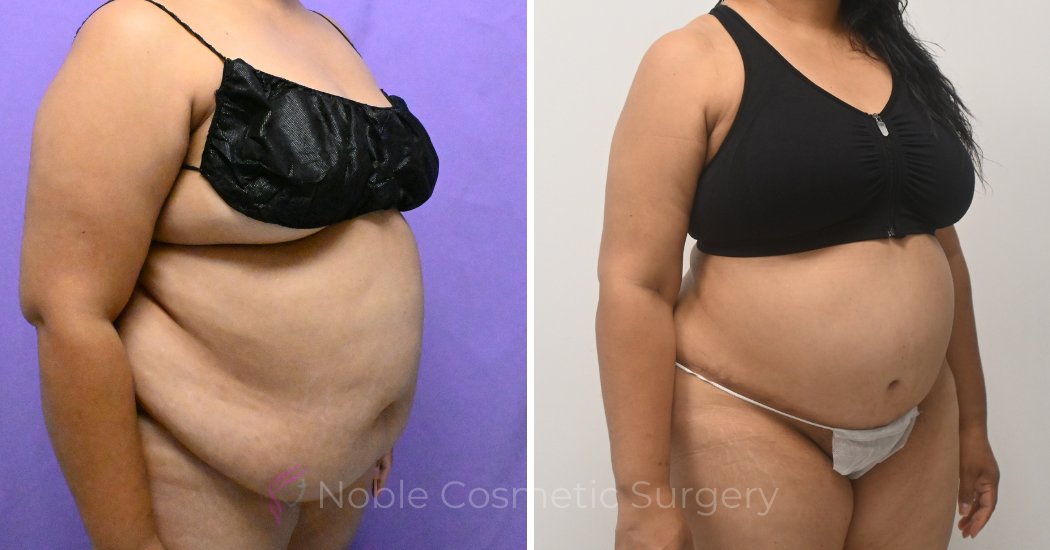 Case--10177 | Before and After Abdominoplasty 3