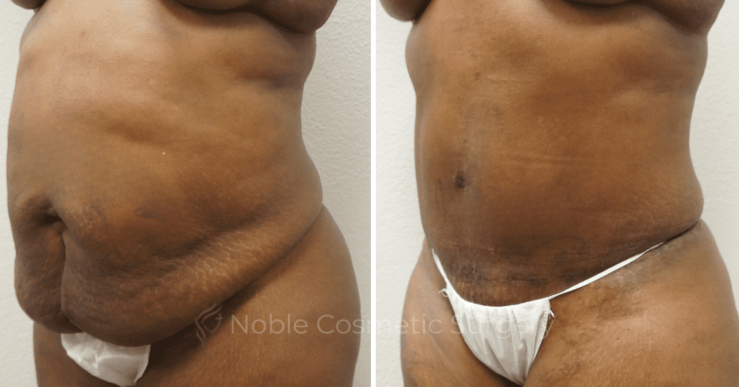 TUMMY-TUCK-CASE-00303 | Before and After Abdominoplasty 2