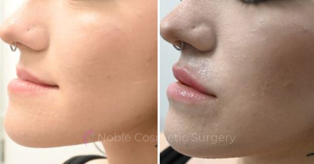 DERMAL-FILLERS-CASE-00265 | Before and After Dermal Fillers 3