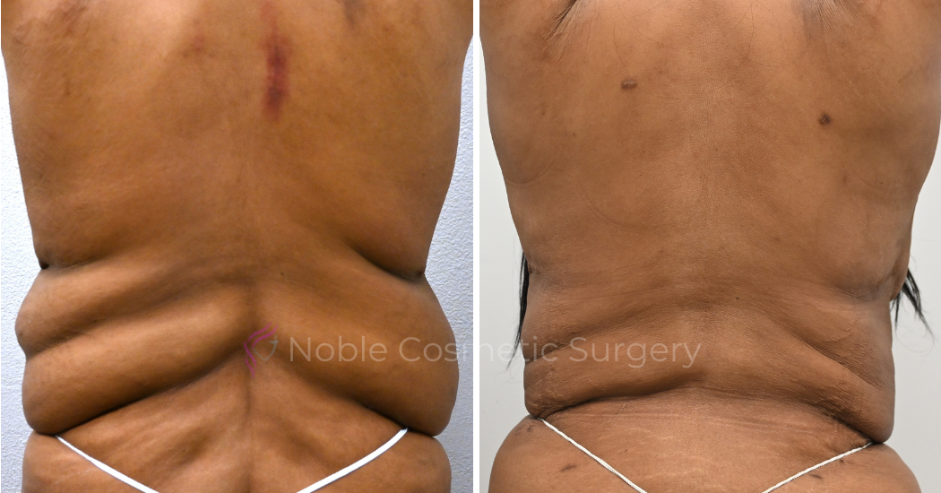 TUMMY-TUCK-CASE-00036 | Before and After Abdominoplasty 2