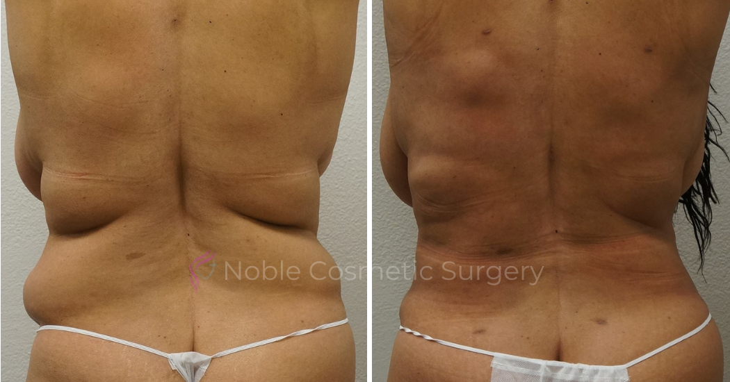 TUMMY-TUCK-CASE-00043 | Before and After Abdominoplasty 3