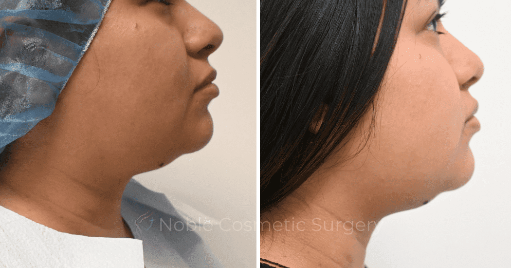 SUBMENTAL-LIPOSUCTION-CASE-10071 | Before and After Chin Liposuction 5