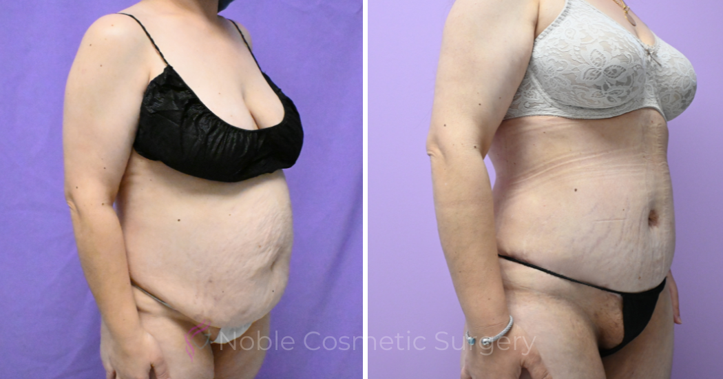 Case--19794 | Before and After Abdominoplasty 3