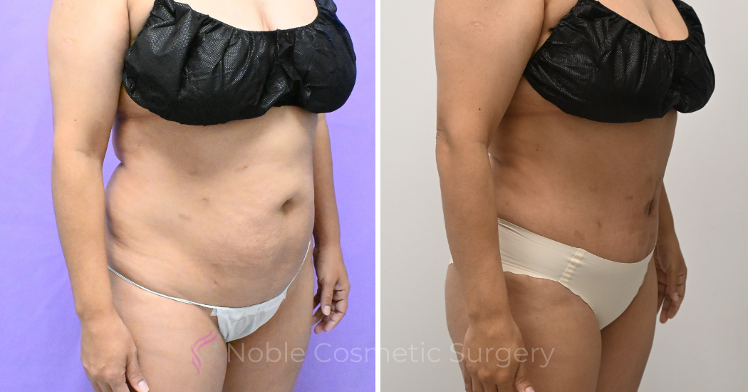 Case--20157 | Before and After Abdominoplasty 3
