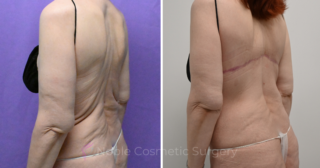 Case--12099 | Before and After Back Lift 3
