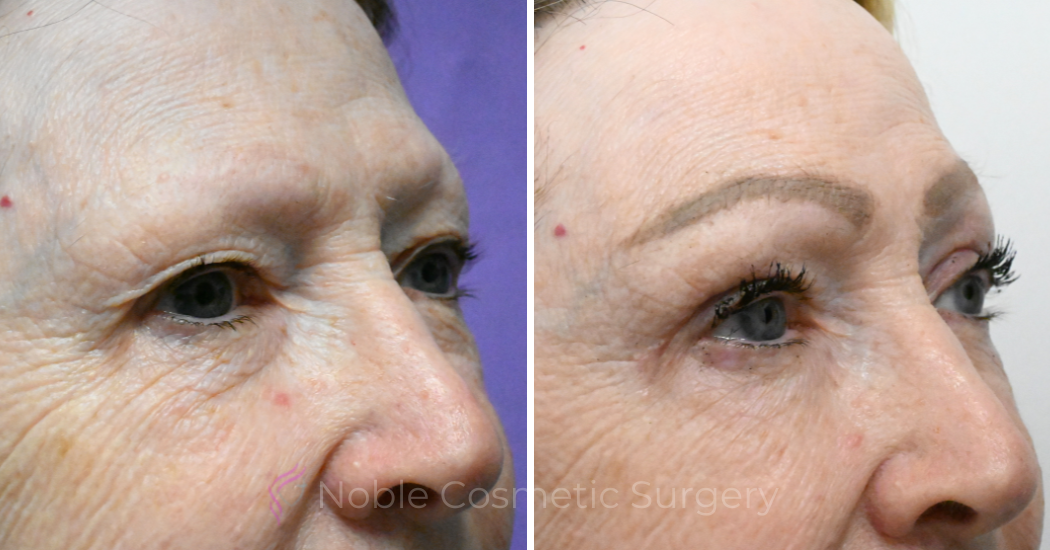 Case--18940 | Before and After Blepharoplasty 3