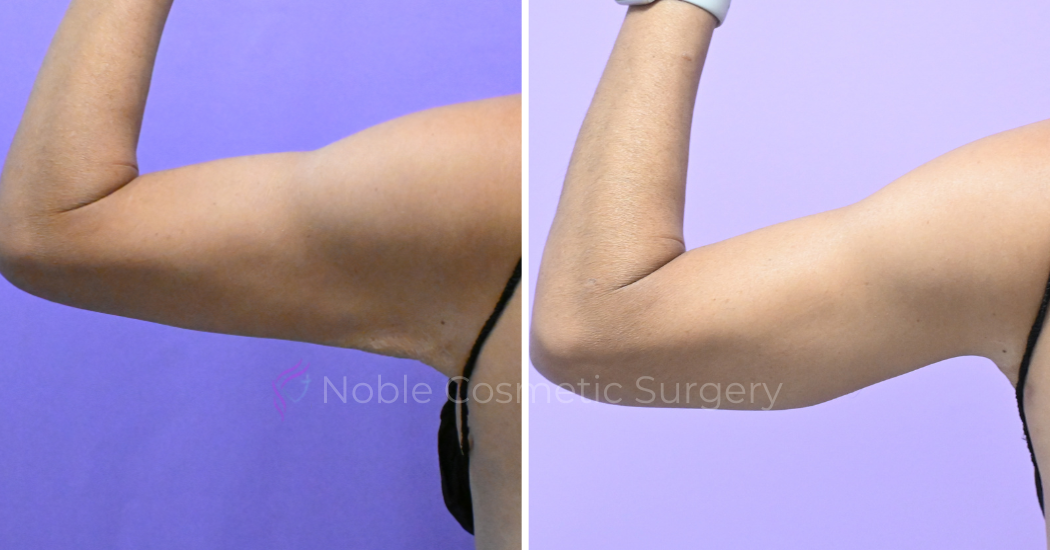 Case--20186 | Before and After Brachioplasty 3