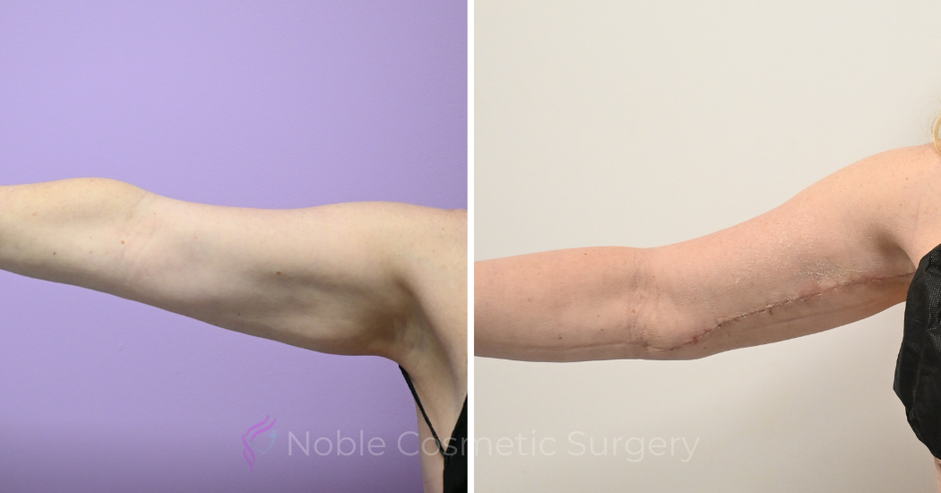 Case--20309 | Before and After Brachioplasty 3
