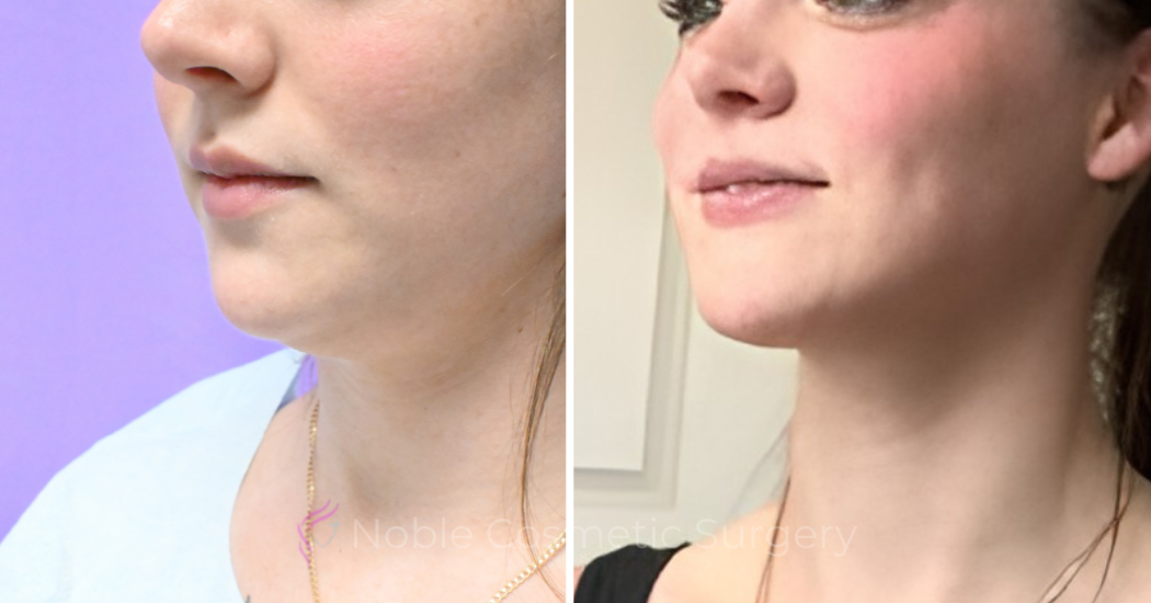 Case--20184 | Before and After Chin Liposuction 3