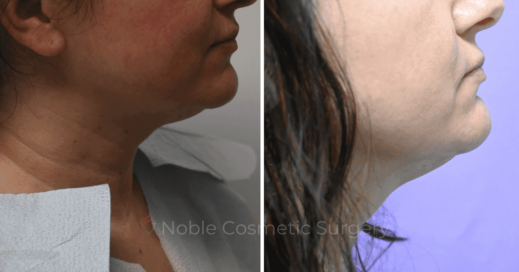 LIPOSUCTION-SUBMENTAL-19131 | Before and After Chin Liposuction