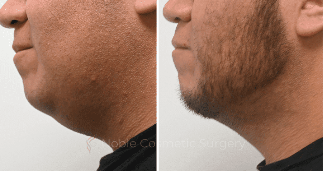 SUBMENTAL-LIPOSUCTION-CASE-19137 | Before and After Chin Liposuction 3