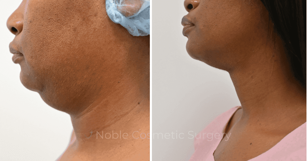 SUBMENTAL-LIPOSUCTION-CASE-12998 | Before and After Chin Liposuction 2