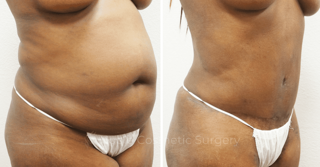 TUMMY-TUCK-CASE-00305 | Before and After Abdominoplasty 2