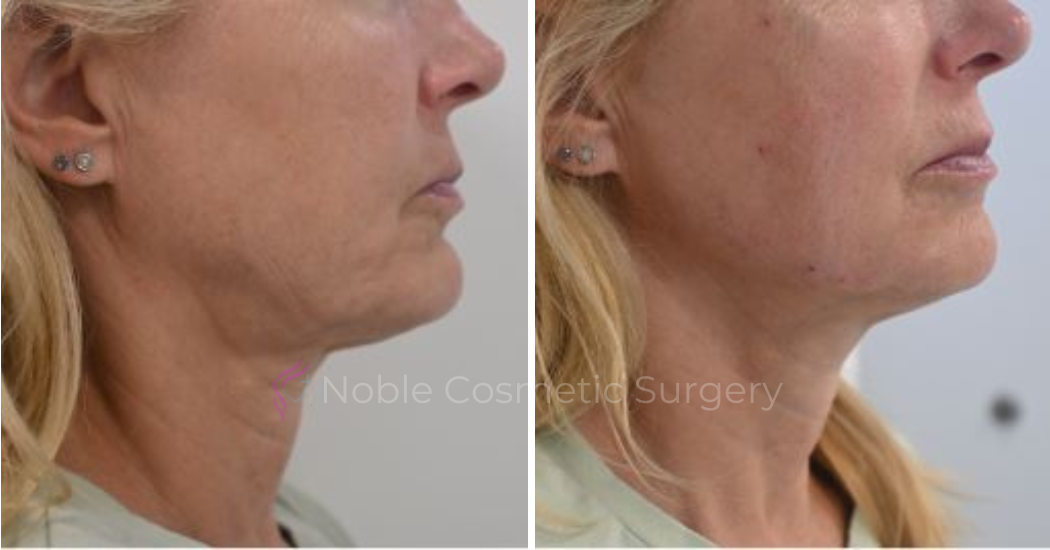 RF-MICRONEEDLING-CASE-00050 | Before and After RF Microneedling 2