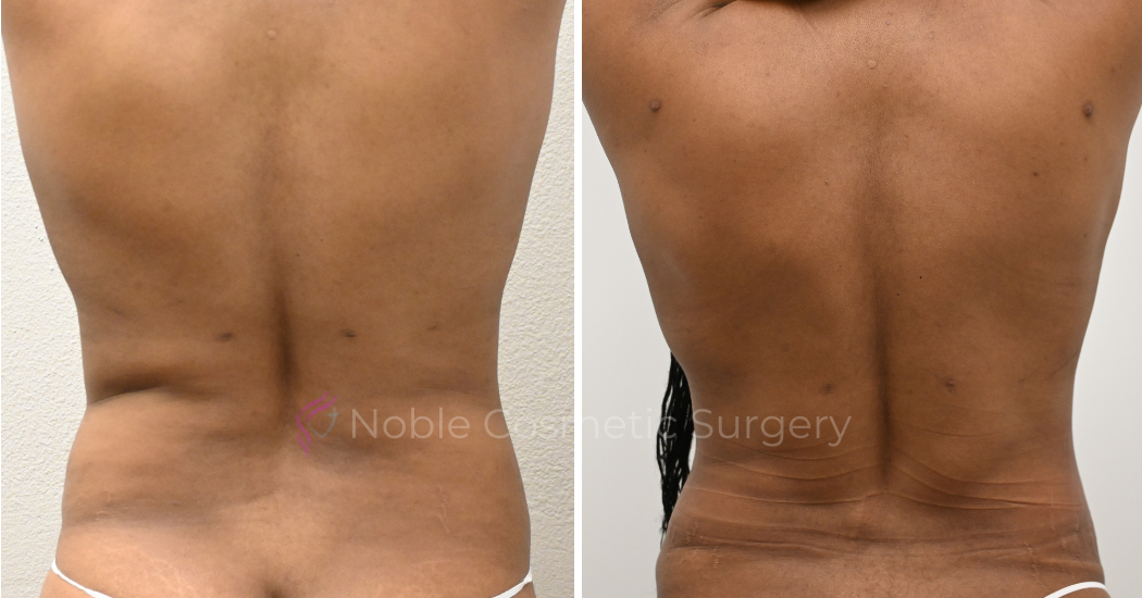 TUMMY-TUCK-CASE-00037 | Before and After Abdominoplasty 3