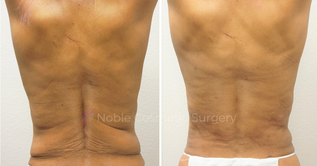 TUMMY-TUCK-CASE-00050 | Before and After Abdominoplasty 3