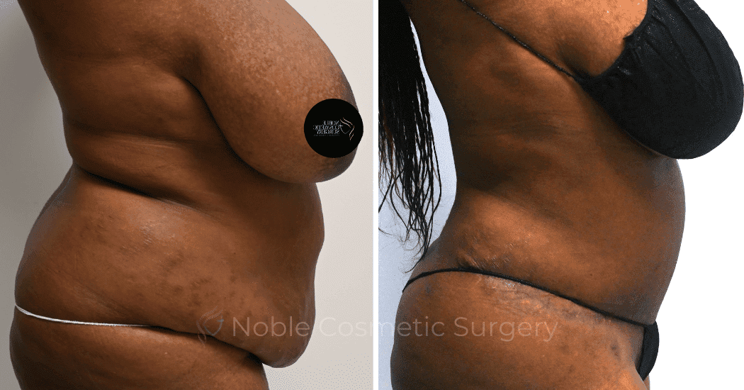 TUMMY-TUCK-CASE-11720 | Before and After Abdominoplasty 3