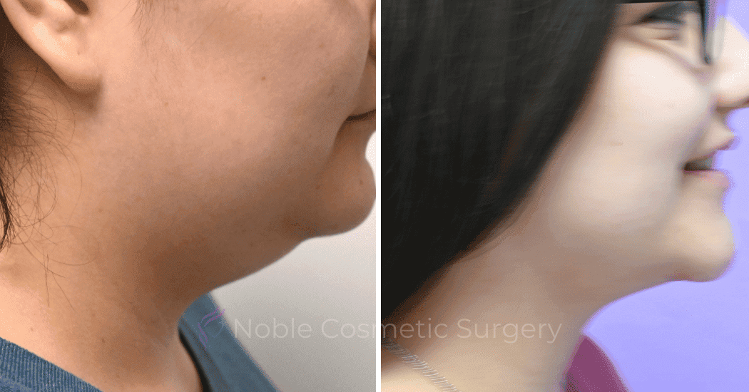 SUBMENTAL-LIPOSUCTION-CASE-10173 | Before and After Chin Liposuction 2