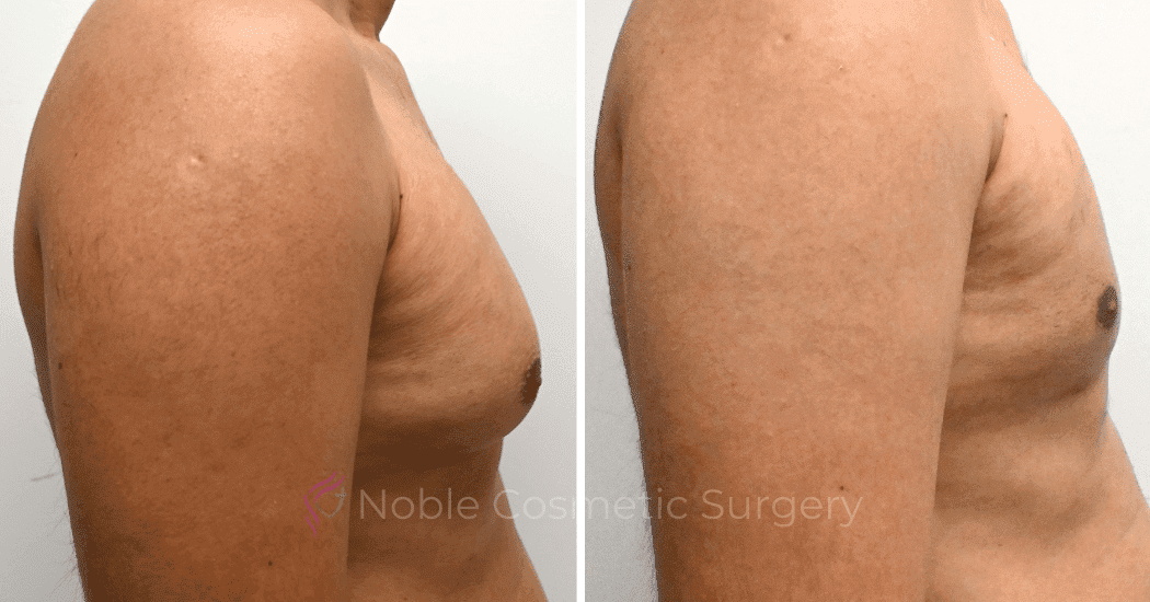 GYNECOMASTIA-CASE-10707 | Before and After Gynecomastia 2