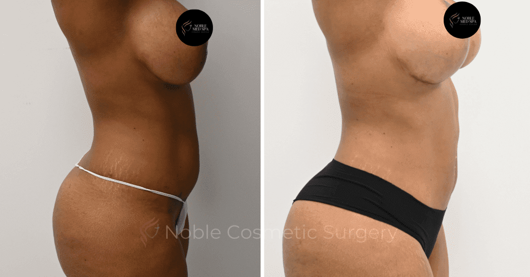 MOMMY-MAKEOVER-CASE-16458 | Before and After Mommy Makeover 3