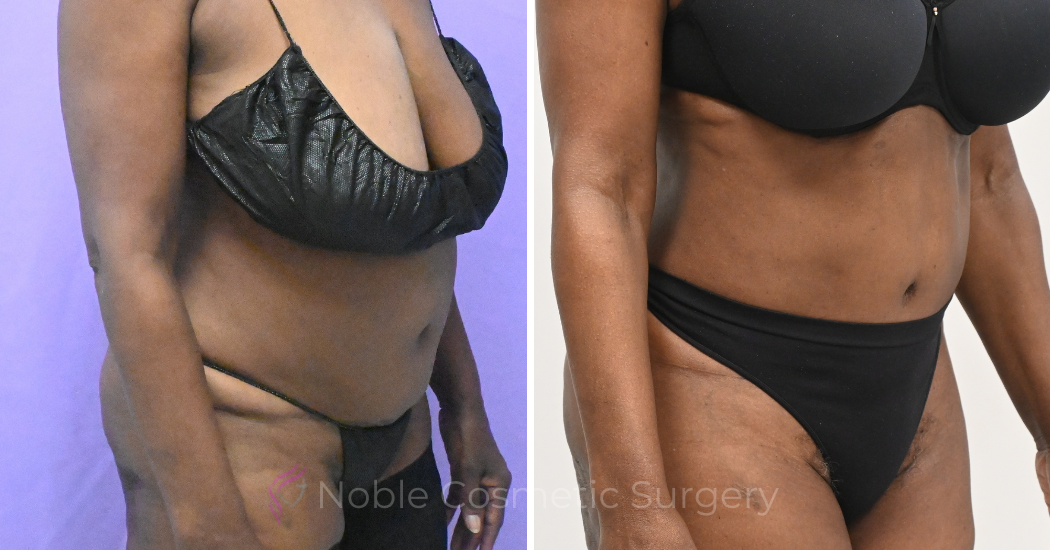 Case--19632 | Before and After Liposuction 3