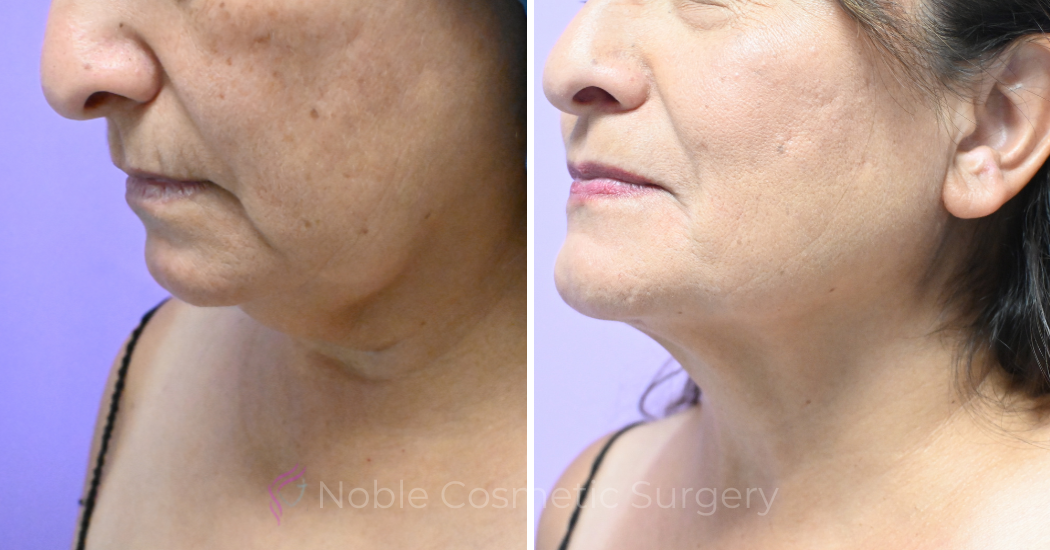 Case--19506 | Before and After Chin Liposuction 3