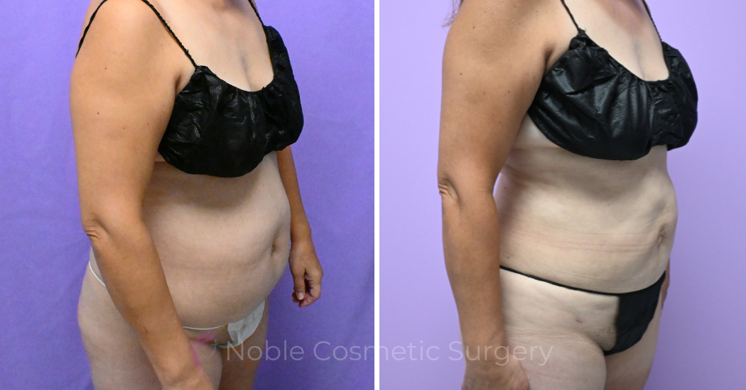 Case---19506 | Before and After Liposuction 3
