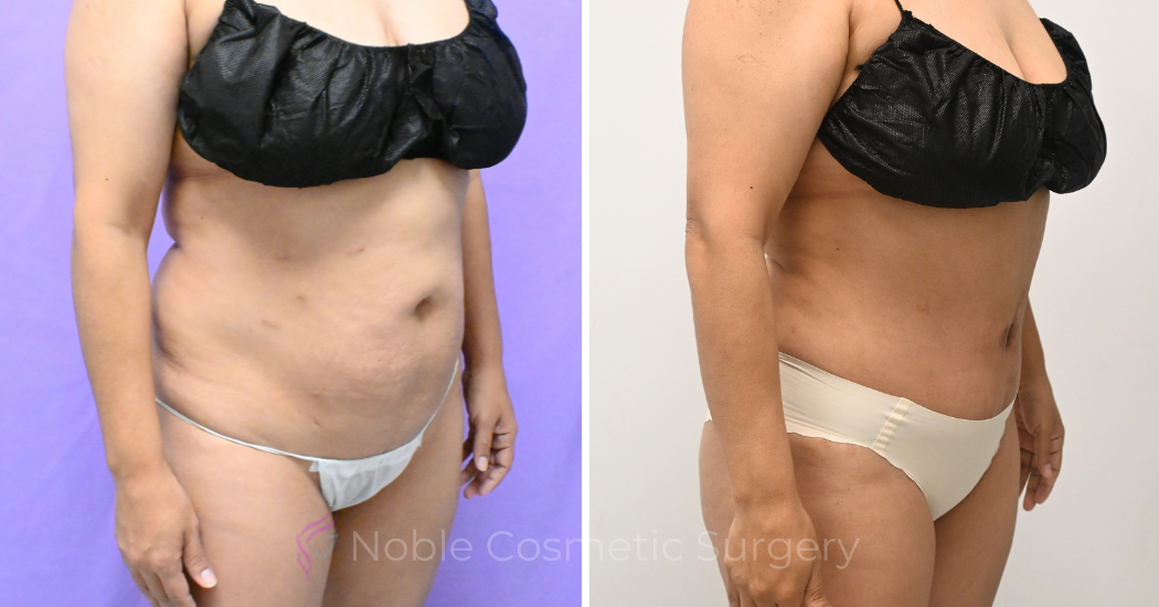 Case--20157 | Before and After Abdominoplasty 3