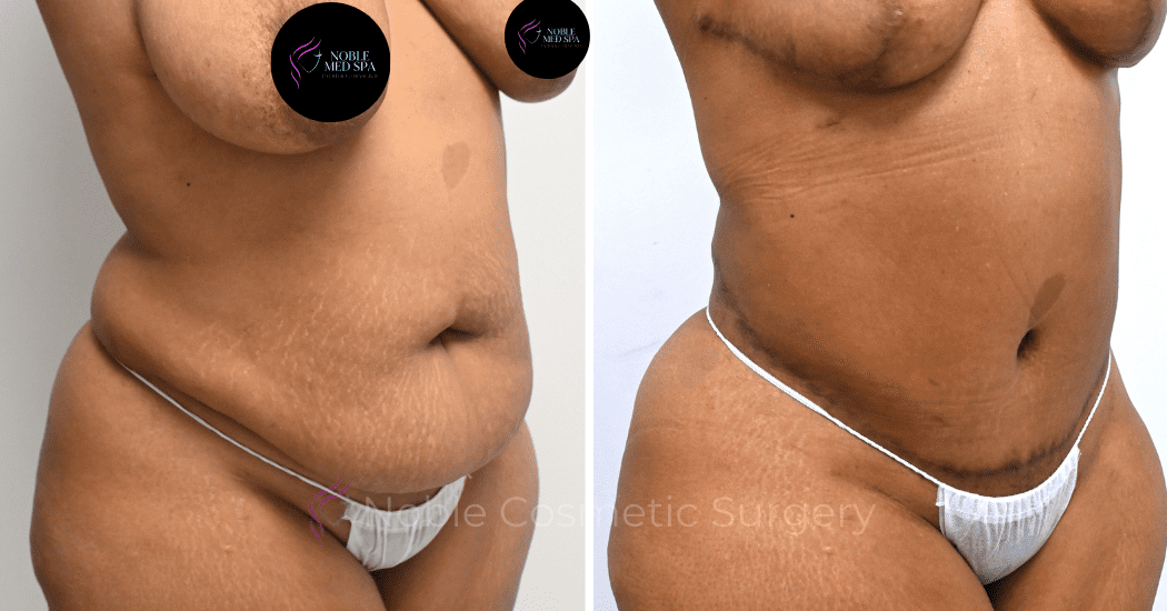TUMMY-TUCK-CASE-00309 | Before and After Abdominoplasty 2