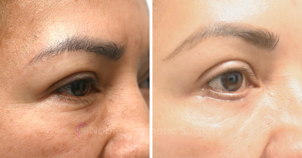 BLEPHAROPLASTY-CASE-19072 | Before and After Blepharoplasty 3