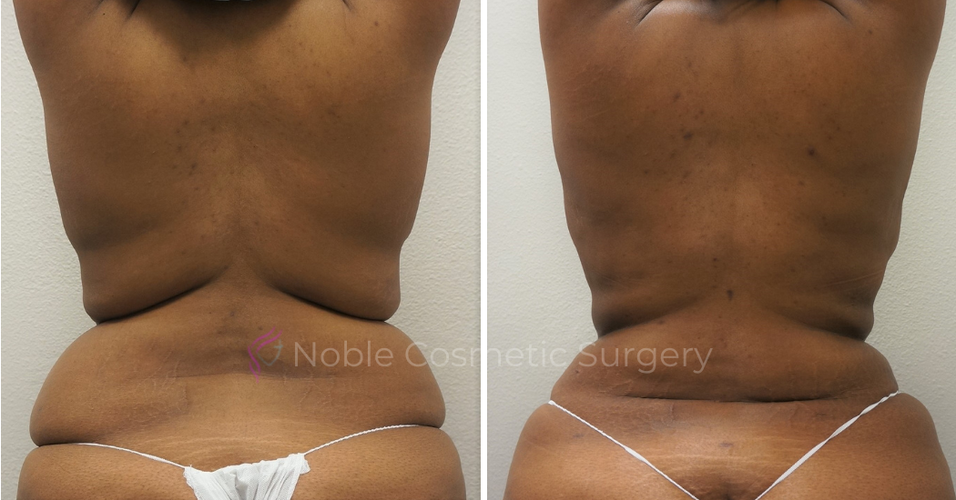 TUMMY-TUCK-CASE-00051 | Before and After Abdominoplasty 3