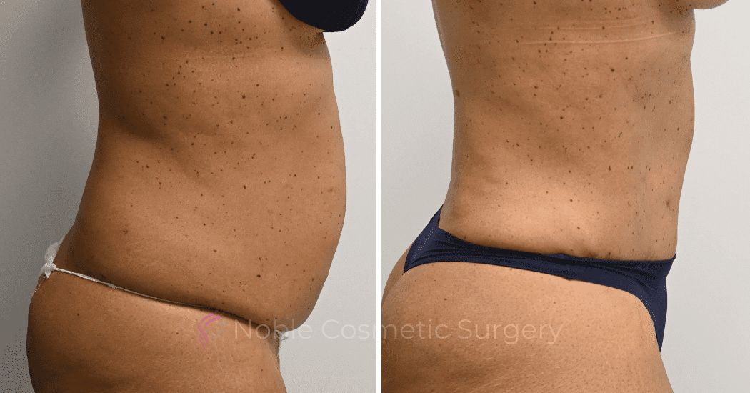 TUMMY-TUCK-CASE-10616 | Before and After Abdominoplasty 3