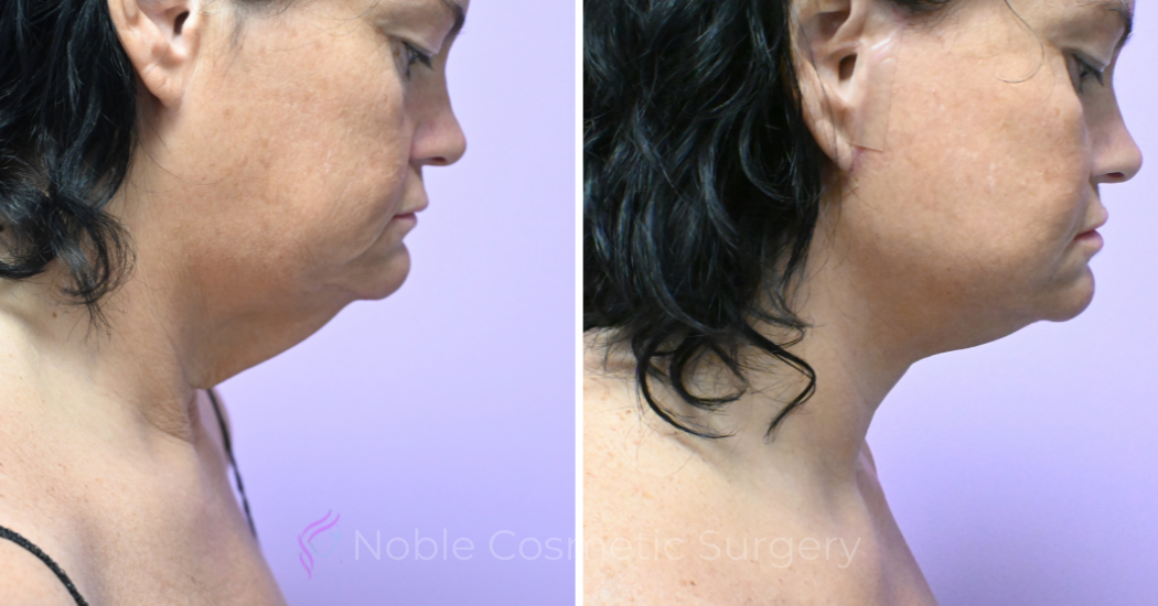 Case--5722 | Before and After Facelift 3