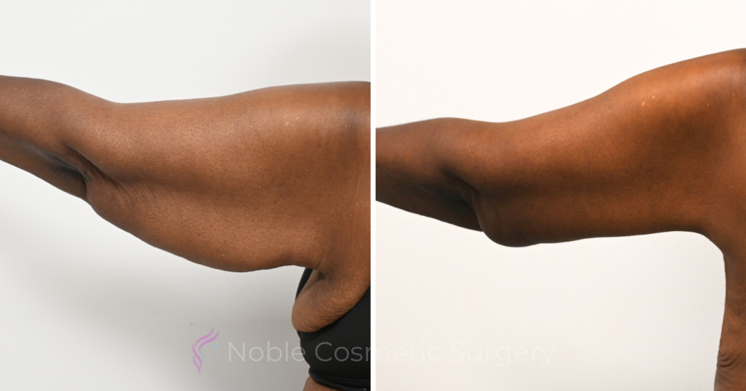 Case--20391 | Before and After Brachioplasty 3