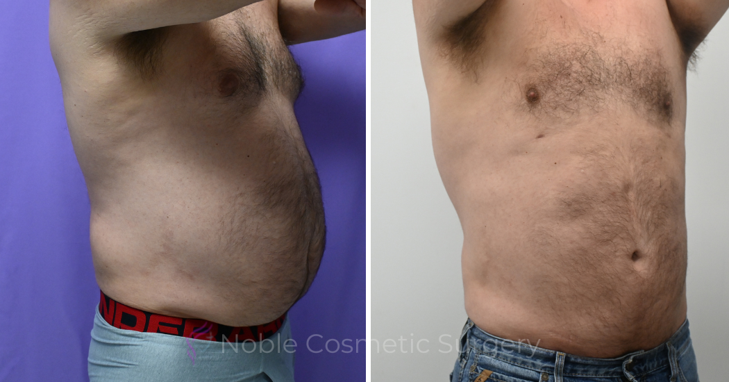 Case--13711 | Before and After Male Liposuction 3