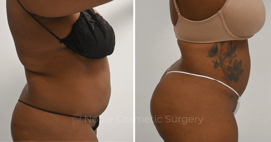 LIPOSUCTION-CASE-10271 | Before and After Liposuction 3